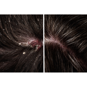 Scalp Health