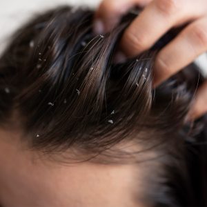 Scalp Health